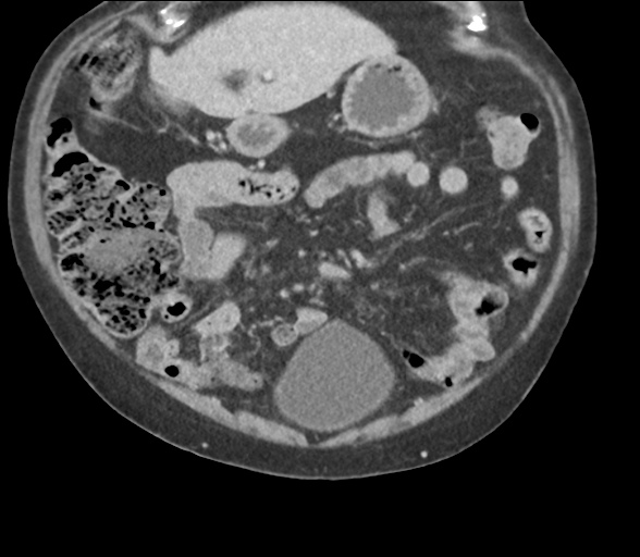File:Bladder papillary urothelial carcinoma (Radiopaedia 48119-52951 C 21).png