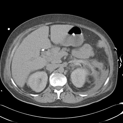 Bladder rupture post renal biopsy (Radiopaedia 30863-31572 Axial non-contrast 31).jpg