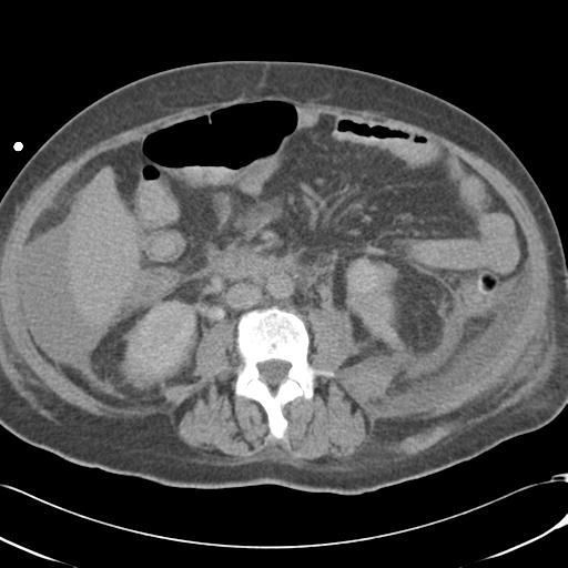 Bladder rupture post renal biopsy (Radiopaedia 30863-31572 Axial non-contrast 46).jpg