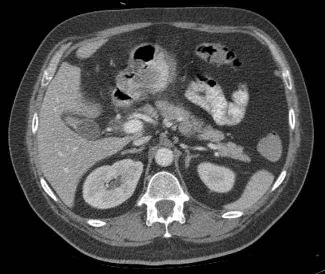 File:Bleeding duodenal ulcer and adenomyomatosis of gallbladder (Radiopaedia 61834-69861 A 33).jpg