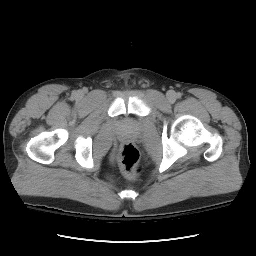 Blunt abdominal trauma with solid organ and musculoskelatal injury with active extravasation (Radiopaedia 68364-77895 Axial C+ delayed 137).jpg