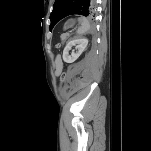 File:Blunt abdominal trauma with solid organ and musculoskelatal injury with active extravasation (Radiopaedia 68364-77895 C 114).jpg