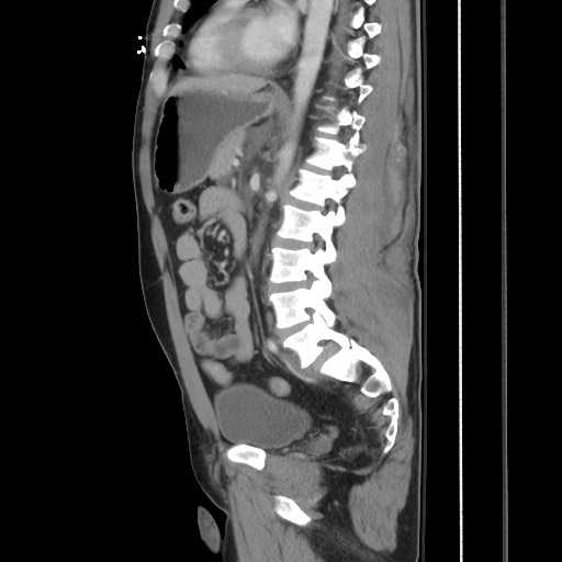 Blunt abdominal trauma with solid organ and musculoskelatal injury with active extravasation (Radiopaedia 68364-77895 C 85).jpg
