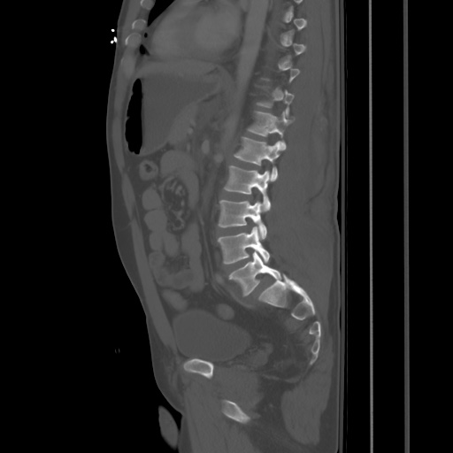 Blunt abdominal trauma with solid organ and musculoskelatal injury with active extravasation (Radiopaedia 68364-77895 Sagittal bone window 60).jpg
