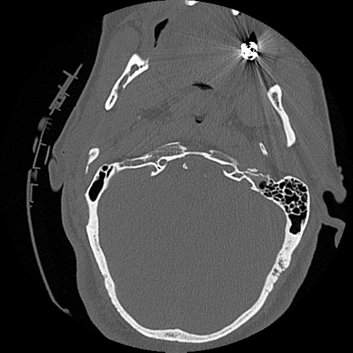 File:Blunt cerebrovascular injury (Radiopaedia 53682-59743 Axial bone window 11).png