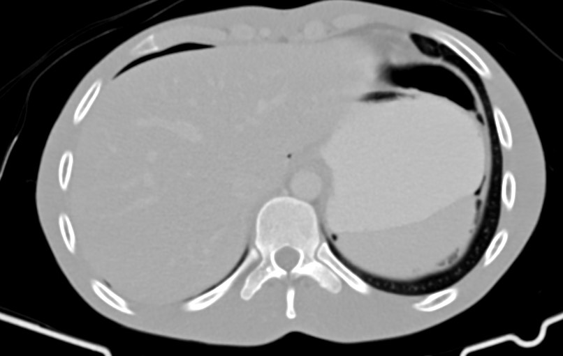 Blunt injury to the small bowel (Radiopaedia 74953-85987 Axial Wide 6).jpg