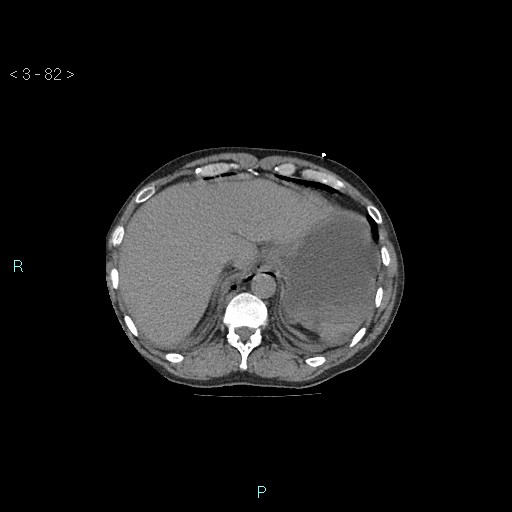 Boerhaave syndrome (Radiopaedia 27683-27897 Axial non-contrast 82).jpg