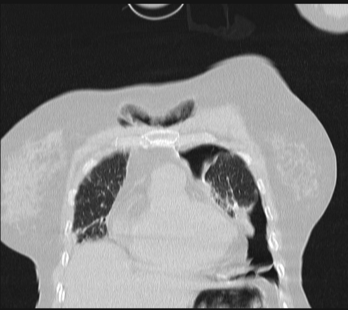 Boerhaave syndrome (Radiopaedia 45644-49799 Coronal lung window 16).jpg