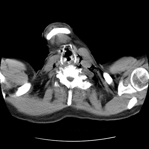 Boerhaave syndrome (Radiopaedia 59796-67310 Axial liver window 4).jpg