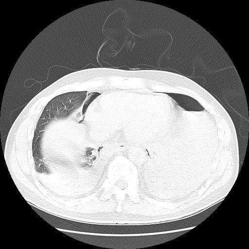 Boerhaave syndrome (Radiopaedia 59796-67310 Axial lung window 47).jpg