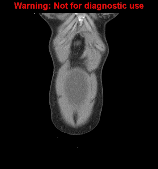 Borderline mucinous cystadenoma of ovary (Radiopaedia 25586-25767 B 1).jpg