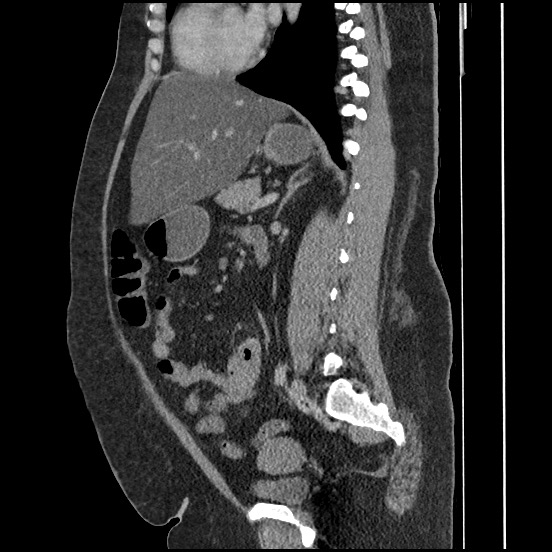 Bowel and splenic infarcts in acute lymphocytic leukemia (Radiopaedia 61055-68913 C 37).jpg