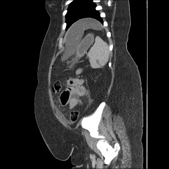 Bowel and splenic infarcts in acute lymphocytic leukemia (Radiopaedia 61055-68915 C 17).jpg