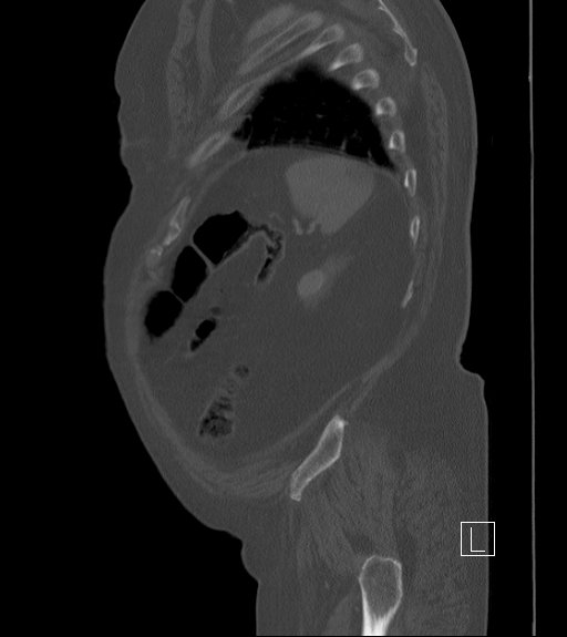 Bowel ischemia secondary to SMA occlusion with extensive portomesenteric venous gas (Radiopaedia 54656-60871 Sagittal bone window 16).jpg