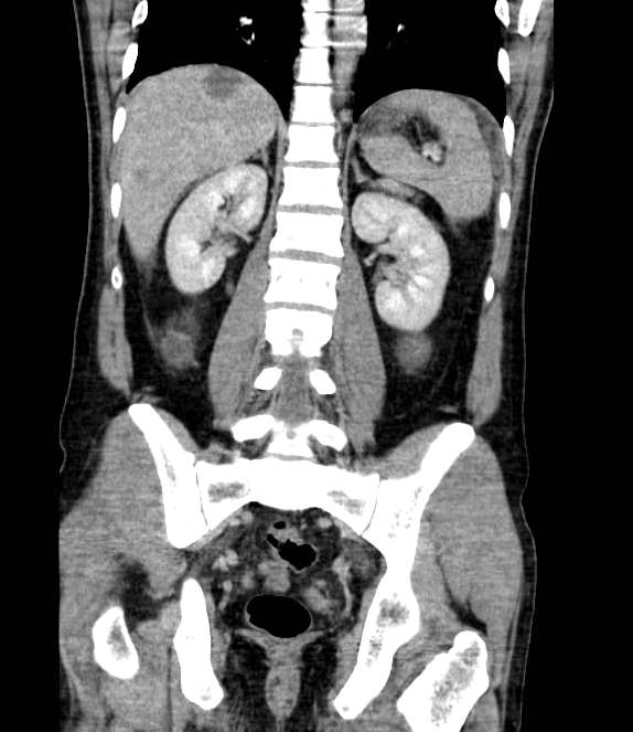 Bowel obstruction from colon carcinoma (Radiopaedia 22995-23028 C 51).jpg