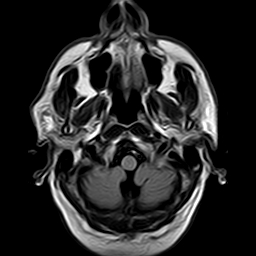 File:Brain abscess complicated by intraventricular rupture and ventriculitis (Radiopaedia 82434-96571 Axial FLAIR 1).jpg
