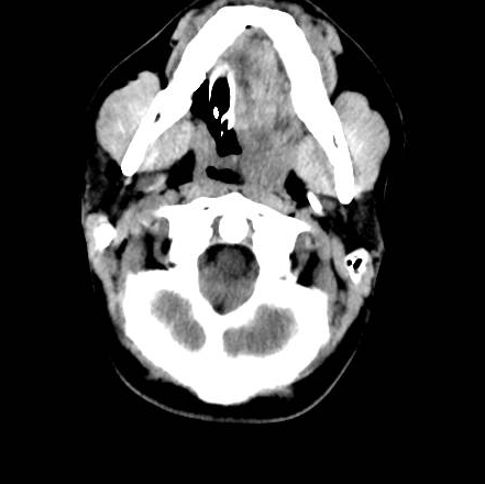 File:Brain death after motor vehicle collision (Radiopaedia 88470-105114 Axial 27).png