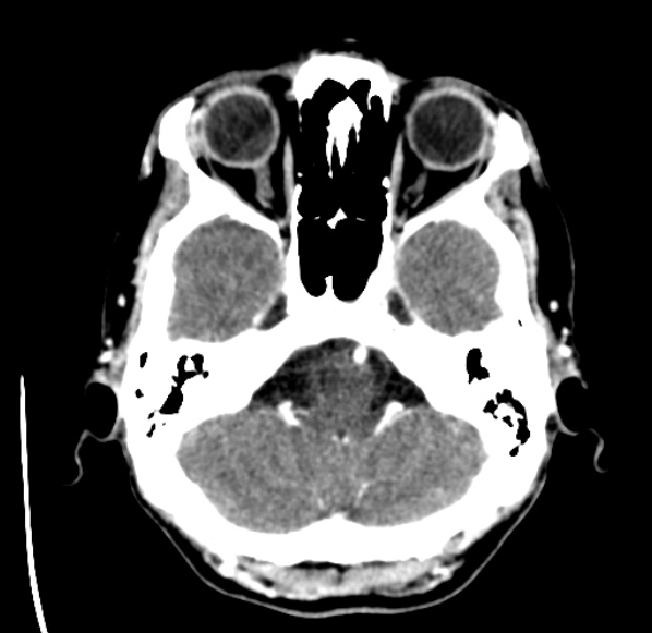 File:Brain metastases from lung cancer (Radiopaedia 24480-24781 Axial C+ delayed 9).jpg