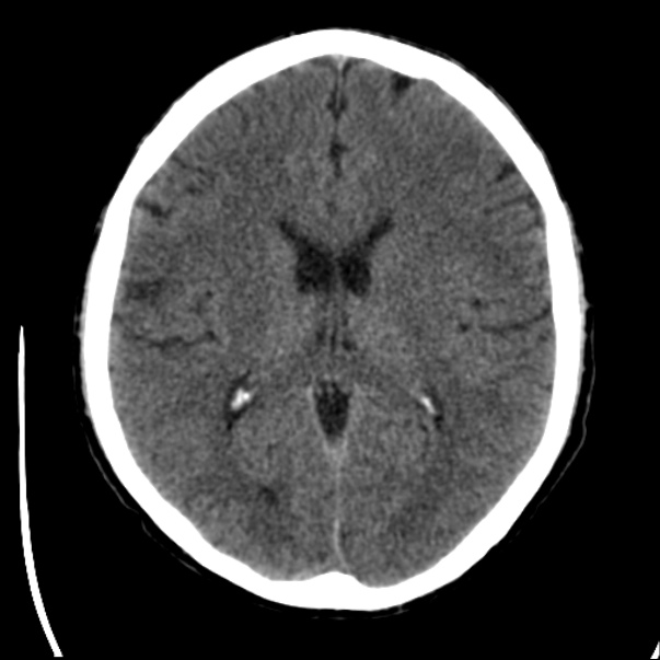 Brain metastases from lung cancer (Radiopaedia 24480-24781 Axial non-contrast 27).jpg