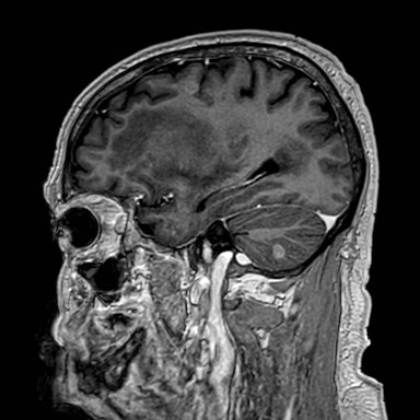 Brain metastases from lung cancer (Radiopaedia 83839-99028 Sagittal T1 C+ 17).jpg
