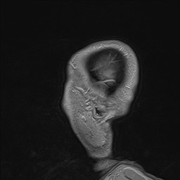Brain metastasis (Radiopaedia 42617-45761 Sagittal T1 C+ 6).jpg