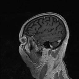 Brain metastasis (Radiopaedia 42617-45761 Sagittal T1 C+ 80).jpg