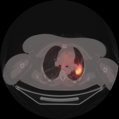 Brain metastasis (Radiopaedia 89847-106962 Axial lung window 22).jpg