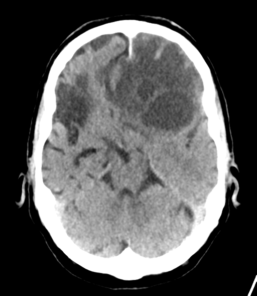 File:Brain metastasis (lung cancer) (Radiopaedia 48289-53177 Axial non-contrast 11).png