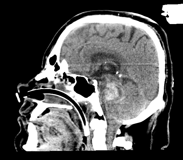 File:Brainstem hemorrhage (Radiopaedia 81294-94976 C 29).jpg