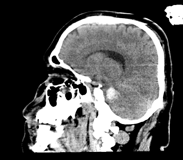 File:Brainstem hemorrhage (Radiopaedia 81294-94976 C 35).jpg