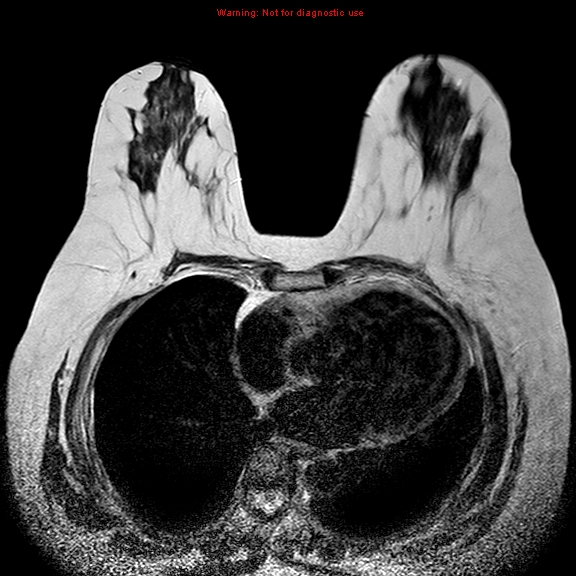 File:Breast carcinoma (multicentric multifocal in mammary Paget disease) (Radiopaedia 50966-56512 Axial T2 5).jpg