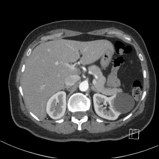 File:Breast metastases from renal cell cancer (Radiopaedia 79220-92225 A 92).jpg