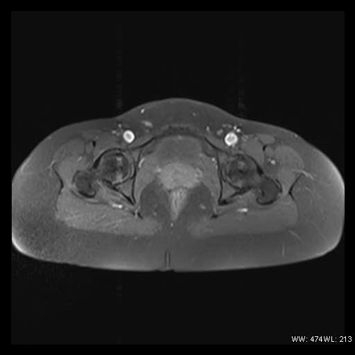 File:Broad ligament fibroid (Radiopaedia 49135-54241 Axial T1 fat sat 23).jpg