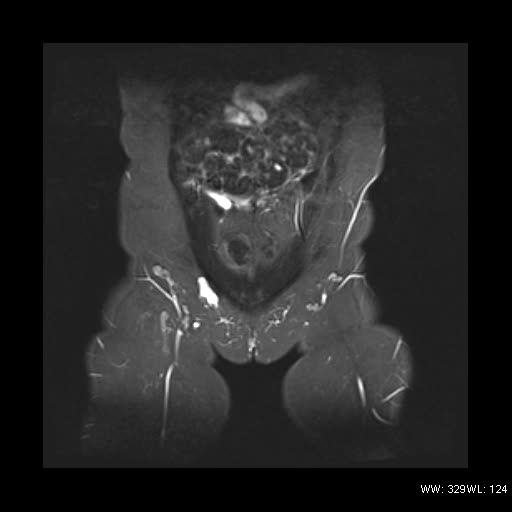 File:Broad ligament fibroid (Radiopaedia 49135-54241 Coronal STIR 4).jpg