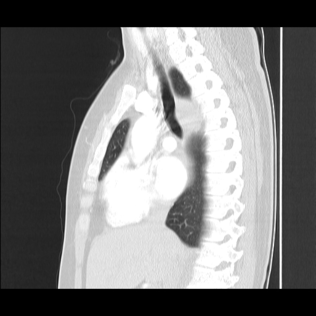 Bronchial atresia (Radiopaedia 22965-22992 Sagittal lung window 30).jpg