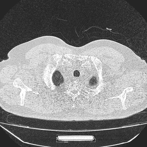 File:Bronchial atresia (Radiopaedia 58271-65417 Axial lung window 2).jpg