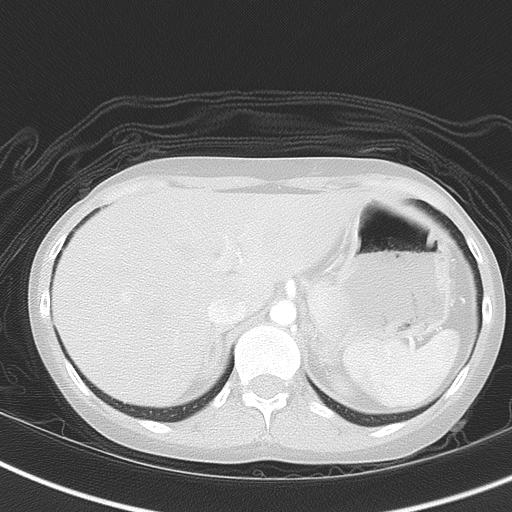 File:Bronchial atresia (Radiopaedia 73677-84470 Axial lung window 55).jpg