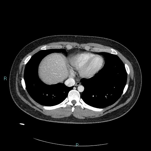 Bronchial carcinoid tumor (Radiopaedia 78272-90875 A 73).jpg