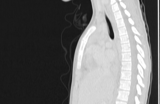 Bronchial mucoepidermoid carcinoma (Radiopaedia 57023-63895 Sagittal lung window 79).jpg