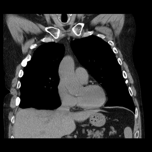 Bronchial stenosis - lung transplant (Radiopaedia 73133-83848 Coronal non-contrast 28).jpg