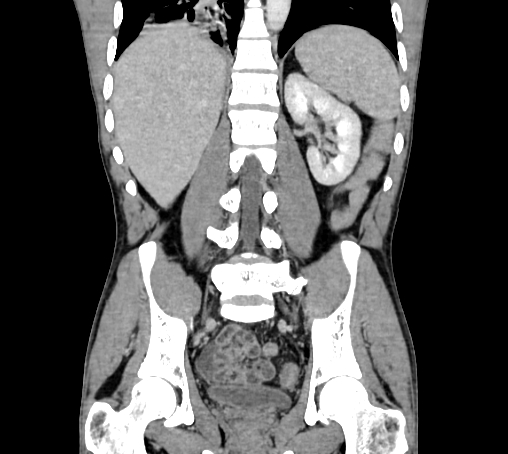 Bronchiectasis in Crohn disease (Radiopaedia 60311-67977 C 55).jpg