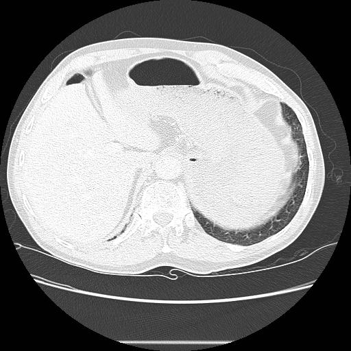 Bronchocele (Radiopaedia 17097-16795 Axial lung window 108).jpg