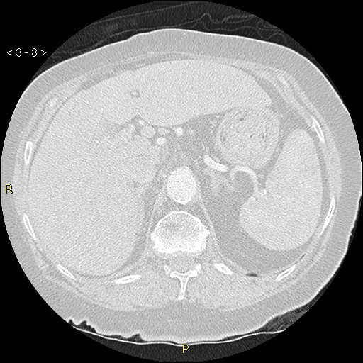 Bronchogenic carcinoma as an incidental finding (Radiopaedia 16453-16130 Axial lung window 8).jpg
