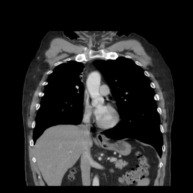Bronchogenic carcinoma with upper lobe collapse (Radiopaedia 29297-29726 D 26).jpg