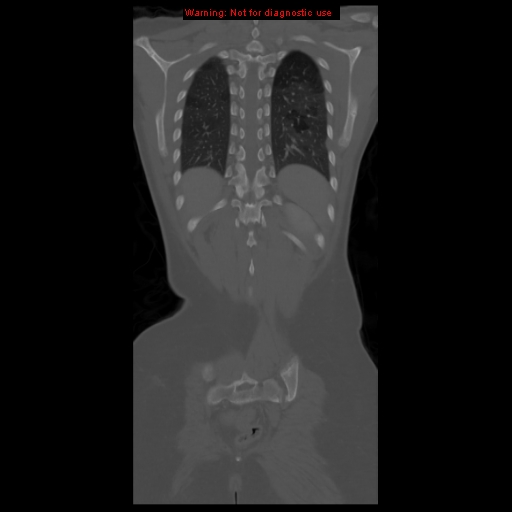 File:Brown tumor (Radiopaedia 12318-12596 D 54).jpg