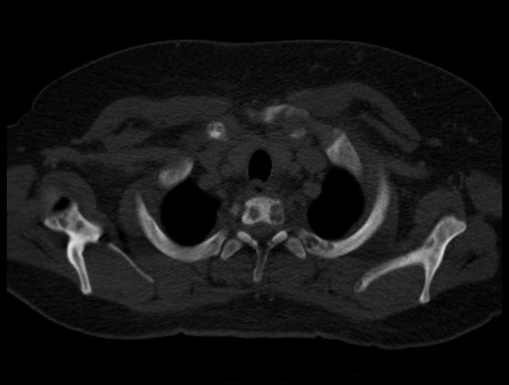 Brown tumors compressing the spinal cord (Radiopaedia 68442-77988 Axial bone window 9).jpg