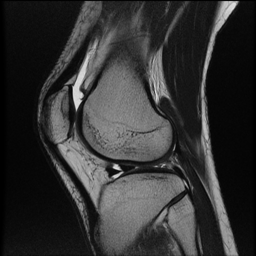 File:Bucket-handle meniscus tear (Radiopaedia 65700-74809 Sagittal T2 18).jpg