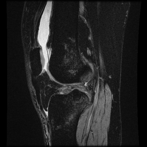 Bucket handle meniscus tear (Radiopaedia 56916-63751 H 34).jpg