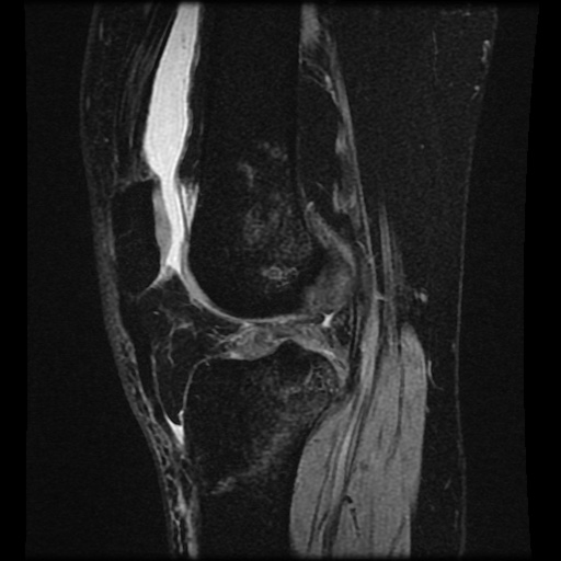 Bucket handle meniscus tear (Radiopaedia 56916-63751 H 35).jpg