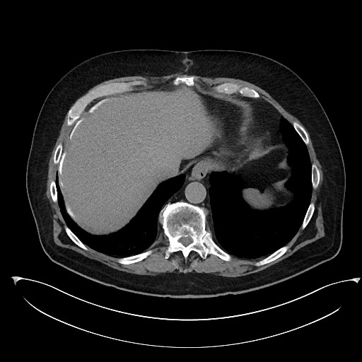 Buried bumper syndrome - gastrostomy tube (Radiopaedia 63843-72577 Axial Inject 15).jpg